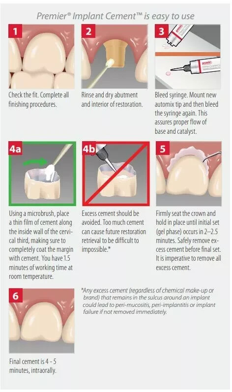 Premier Dental Implant Cement For Implant Retained crowns 5 mL Syringe + 8 Tips