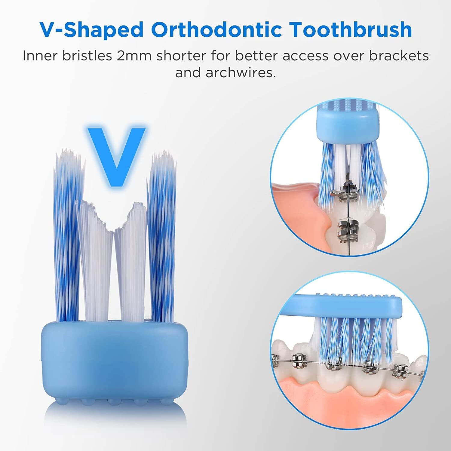 V-Shaped Orthodontic Toothbrush for Braces, Soft Bristles, 6 Count, with…