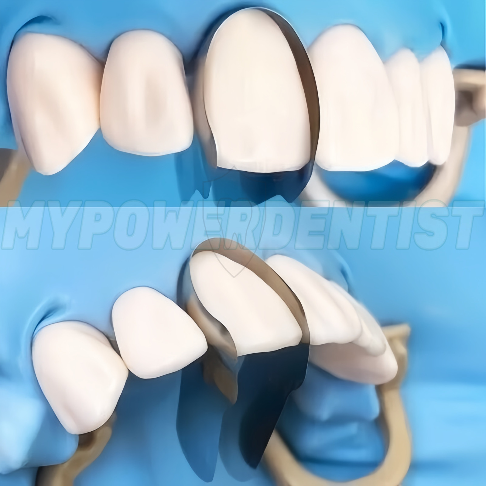 Dental Contoured Anterior Metal Matrix Bands Restoration Sectional M/S Matrices