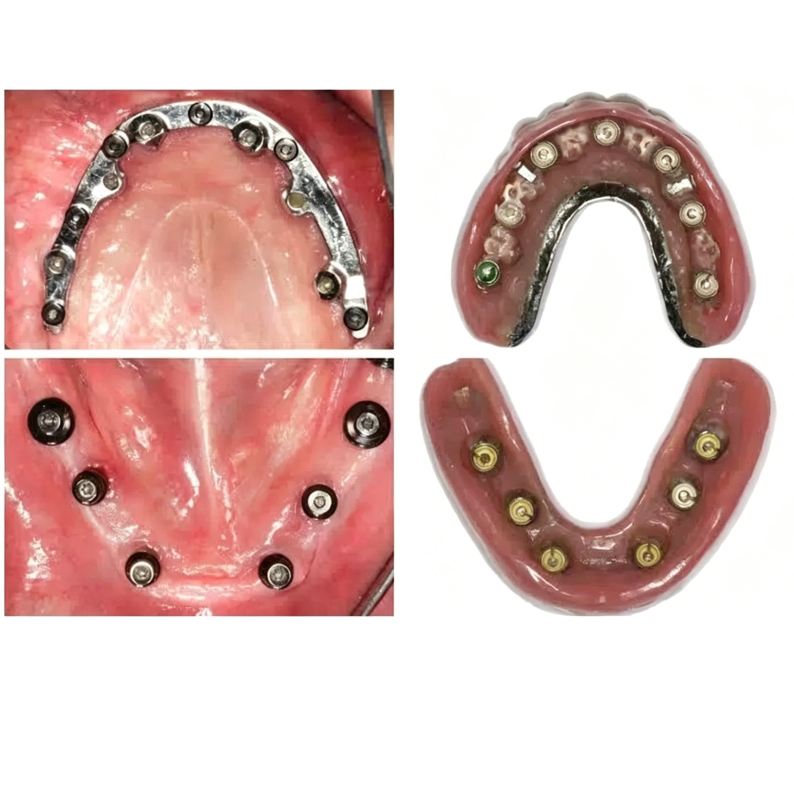 US Novaloc Retention Caps Inserts Kit & Locator Core Tool Overdenture Mounting