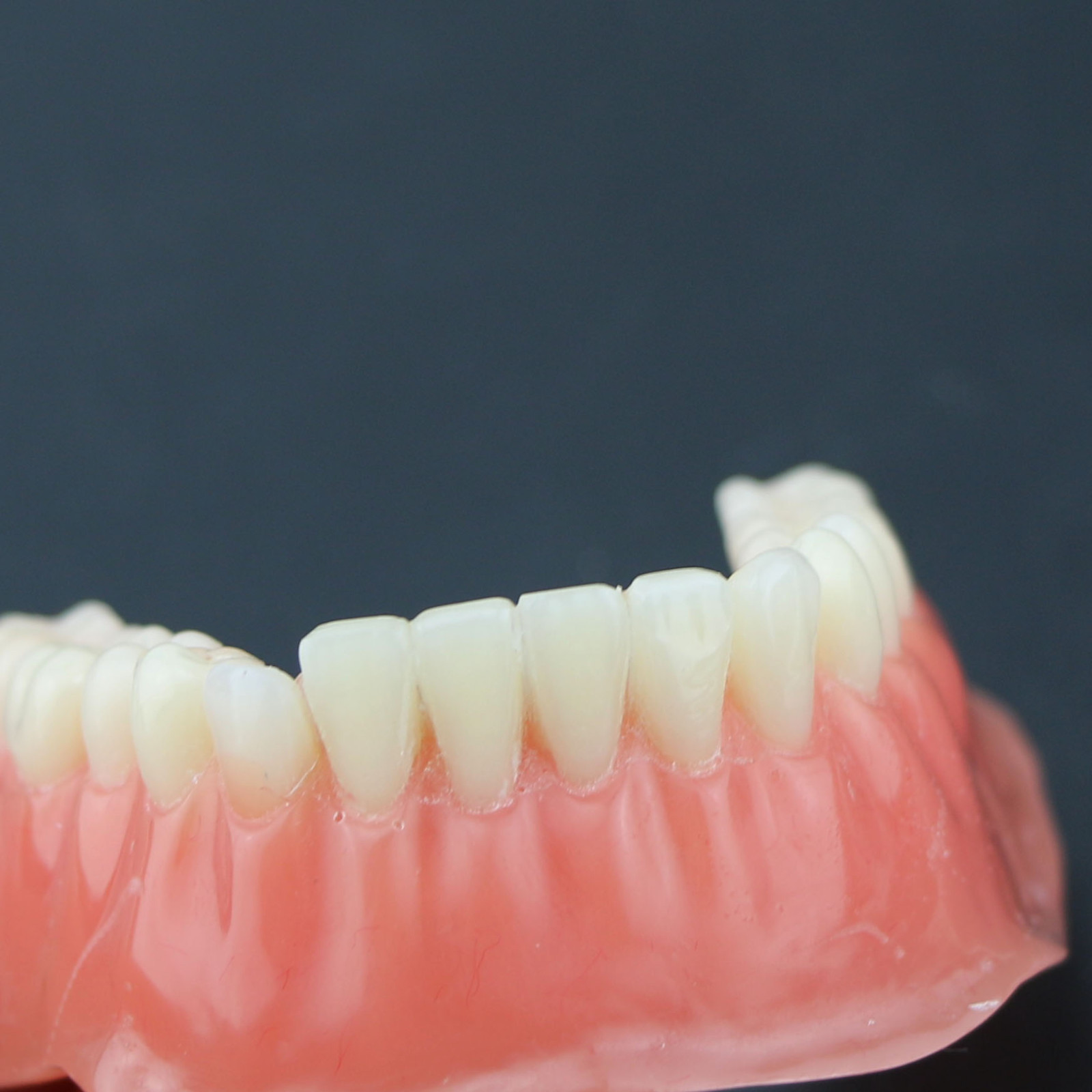 Dental Teeth Implant Model Inferior Overdenture 4 Implants Denture Demo Training