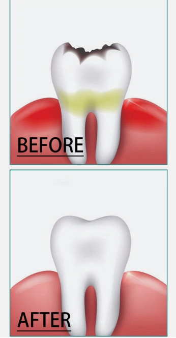 Dental Cavity Healing Tooth Armor Liquid Tooth Care 60 ml
