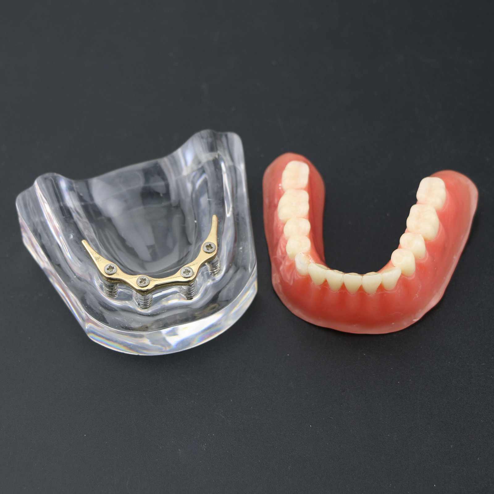 Dental Teeth Implant Model Inferior Overdenture 4 Implants Denture Demo Training