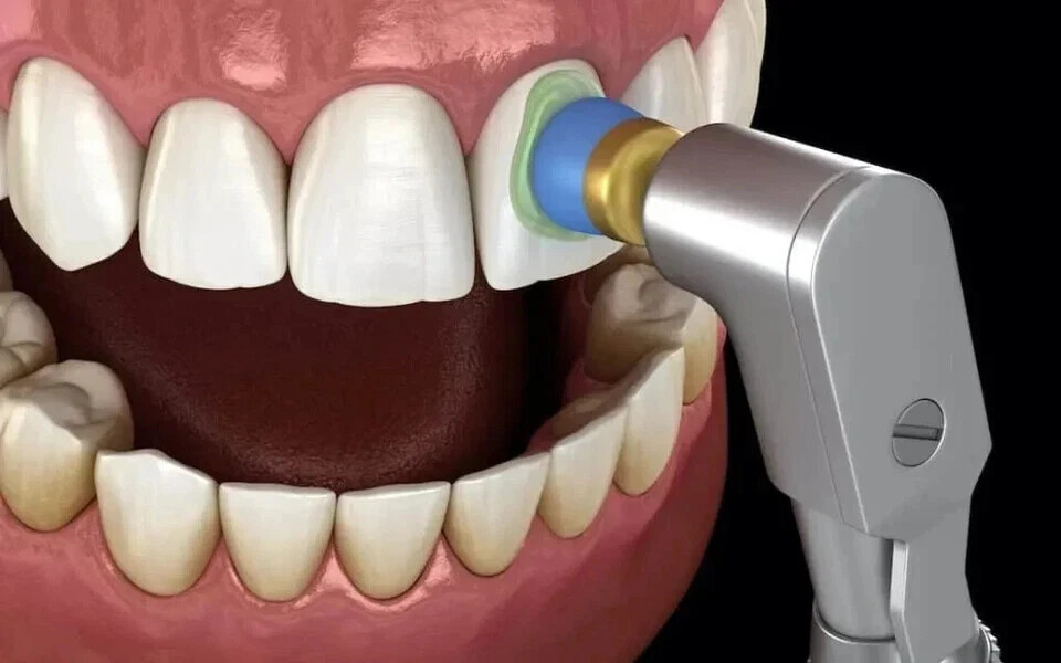 Dental SPECTRA Prophylaxis Polishing Paste After Scaling 75g Jar PINEAPPLE