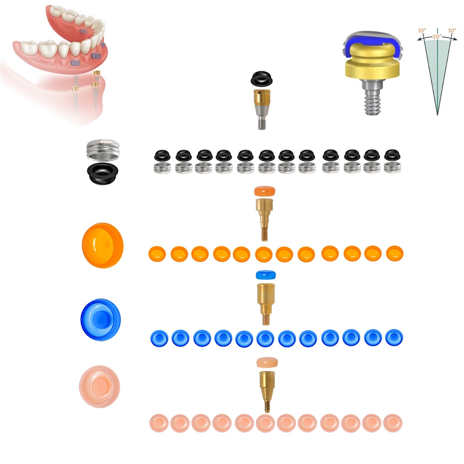 US Dental Locator Overdenture Retention Caps Kit – PEEK Male Inserts & Lab Caps
