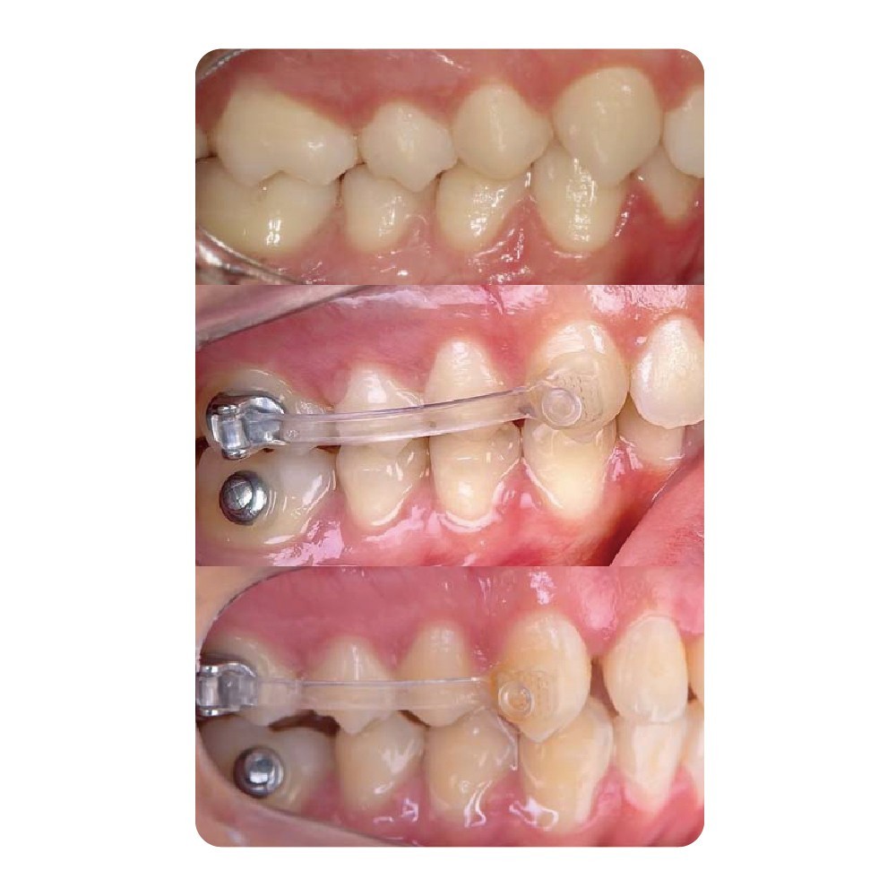 J&J Ortho™ BiteForce NC4 Orthodontic Clear Distalizing Bar Appliance (2/pair)