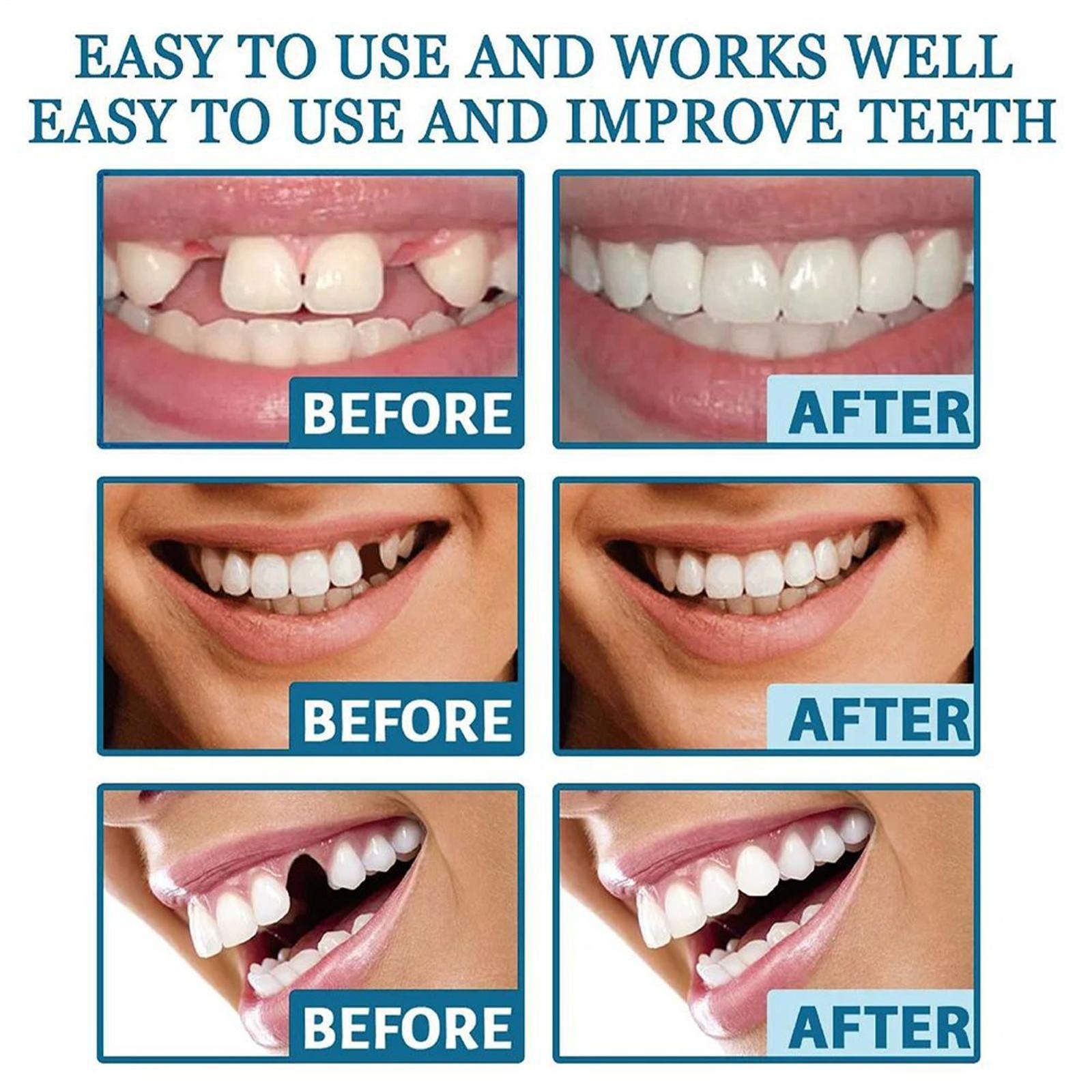 Supplement Syringe Tooth Filler Tooth Repair Resin Teeth Putty Bonding Glue