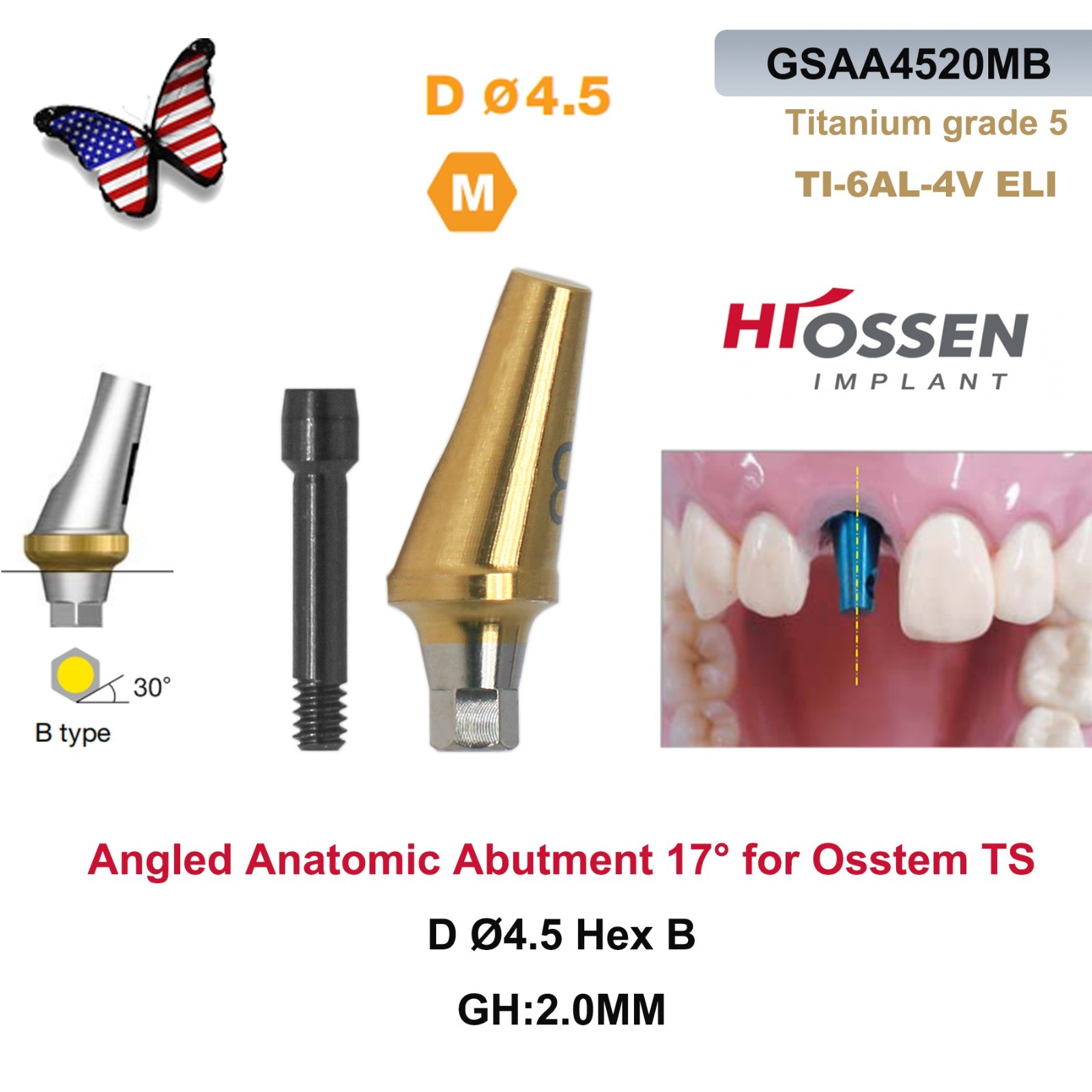 US 5Pcs 17° Angled Anatomic Abutment Hiossen Osstem Mini Regular Hex Titanium
