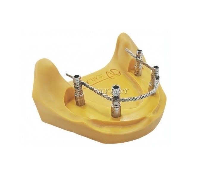 30pcs Dental Implant Connector Stainless Wire Overdenture MU Welded Wires Bonded