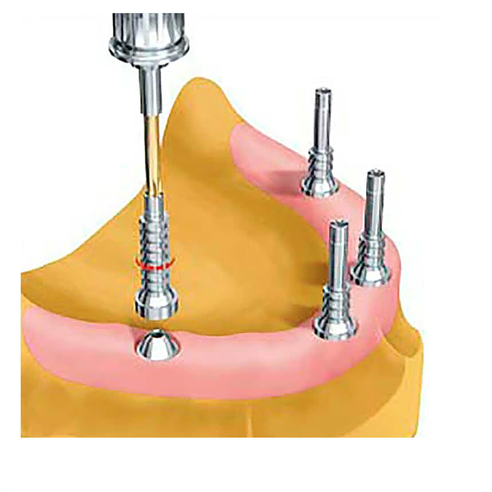 Hiossen/Nobel/Straumann/ITI Ti Temporary Cylinder MU Sleeve Multi Unit Abutment