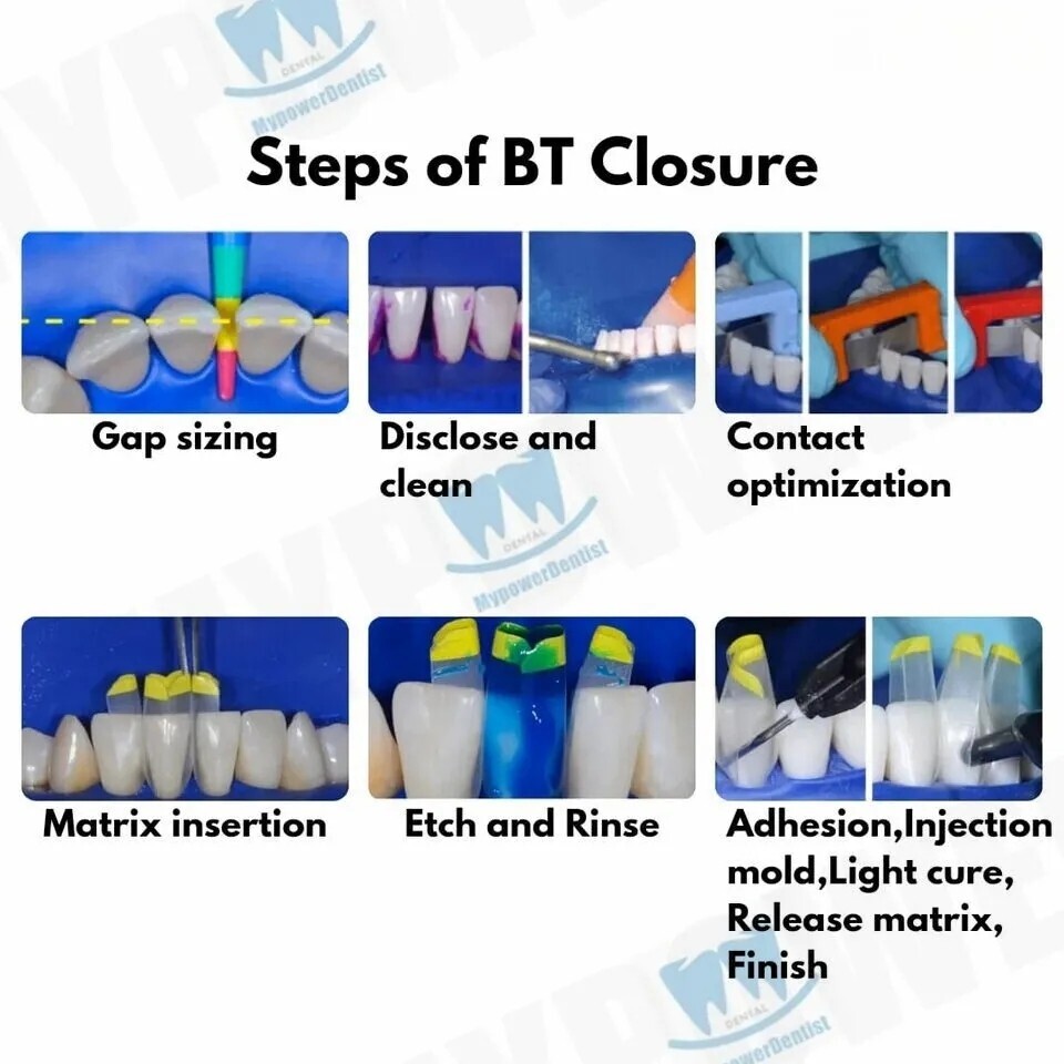 Dental Clear Matrix Diastema Matrices Wedges Similar with BioClear Matrice