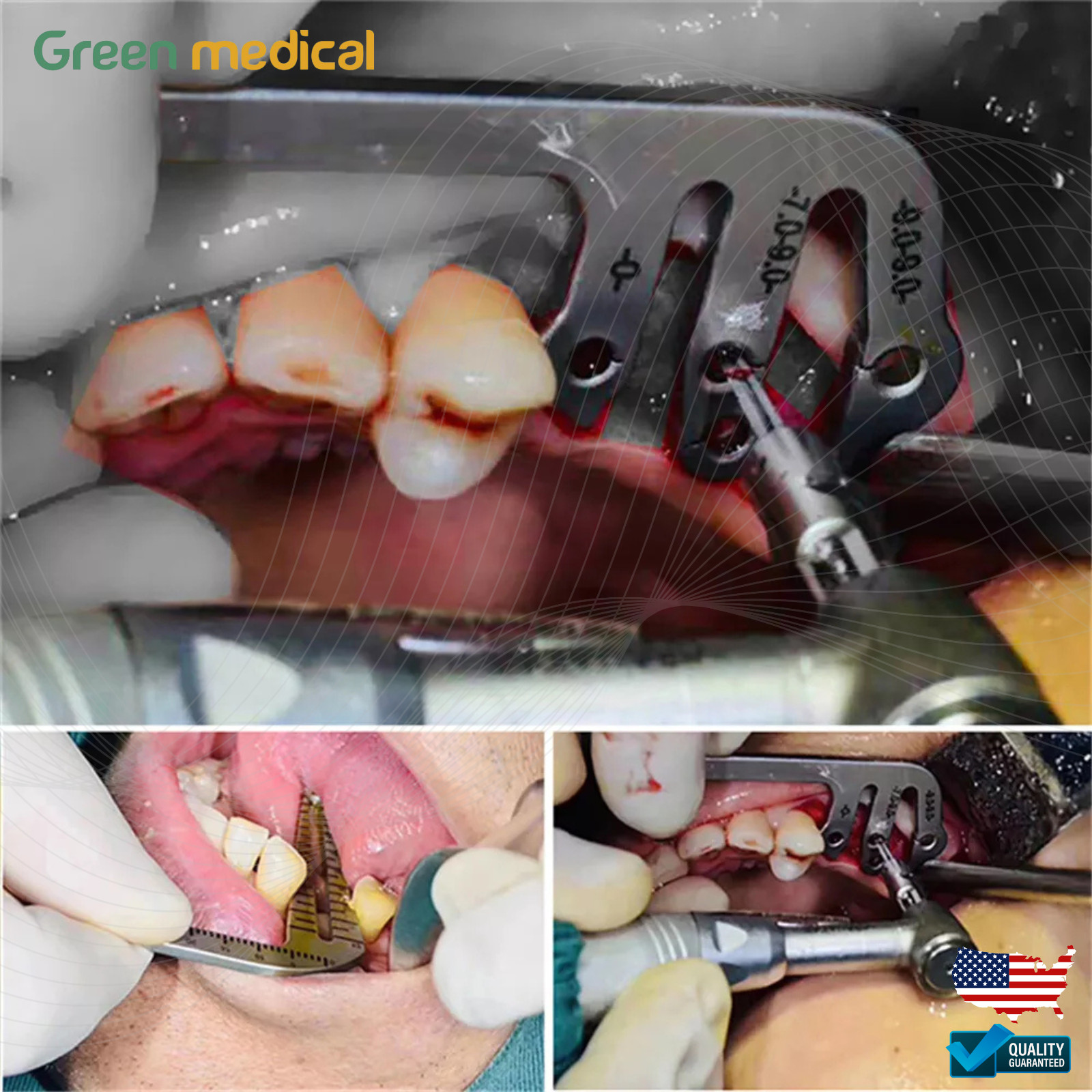 Dental Implant Gauge Surgical Drilling Guide Locator Parallel Depth Pin 5pcs