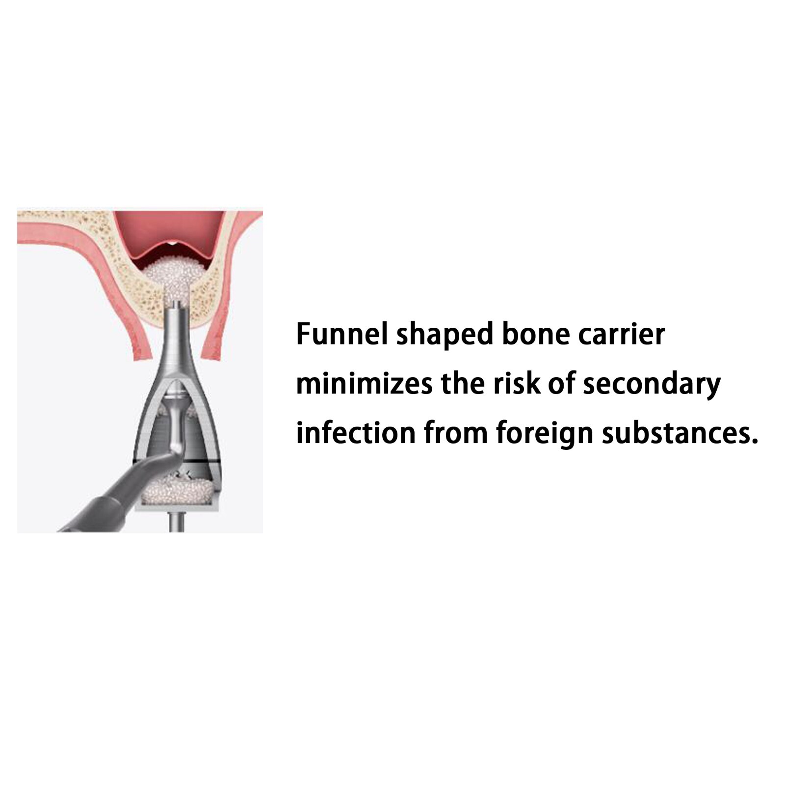 Implant Sinus Lift Kit CAS Hiossen Crestal Approach Hydraulic Membrane Lifter