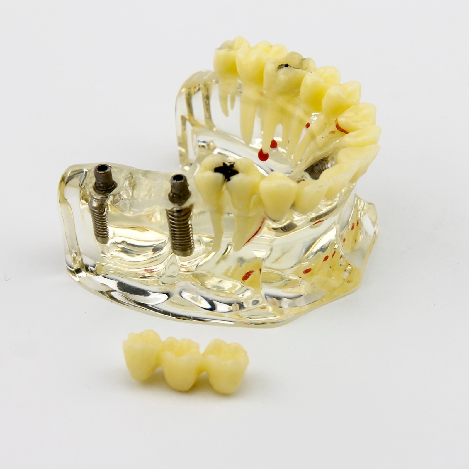 Dental Upper Jaw Implant Model with Bridge and Caries -I 2006