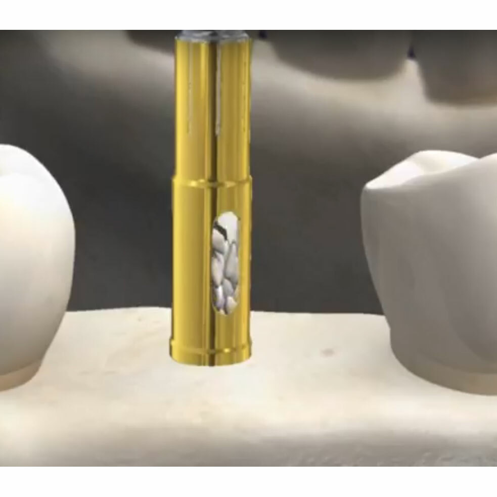 DSI NLBC Dental Implant Surgical Bone Graft Harvest Collector Augmentation 9Pcs