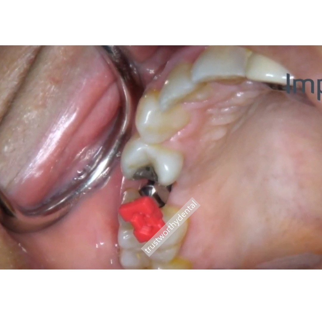 RN Dental ITI lmpression Coping Caps Closed Tray Plastic Caps Transfer Red