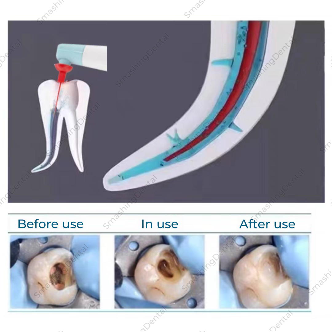 Dental Sonic Irrigator Tips Endo Sonic Activator Tips For Root Canal Dental Tool