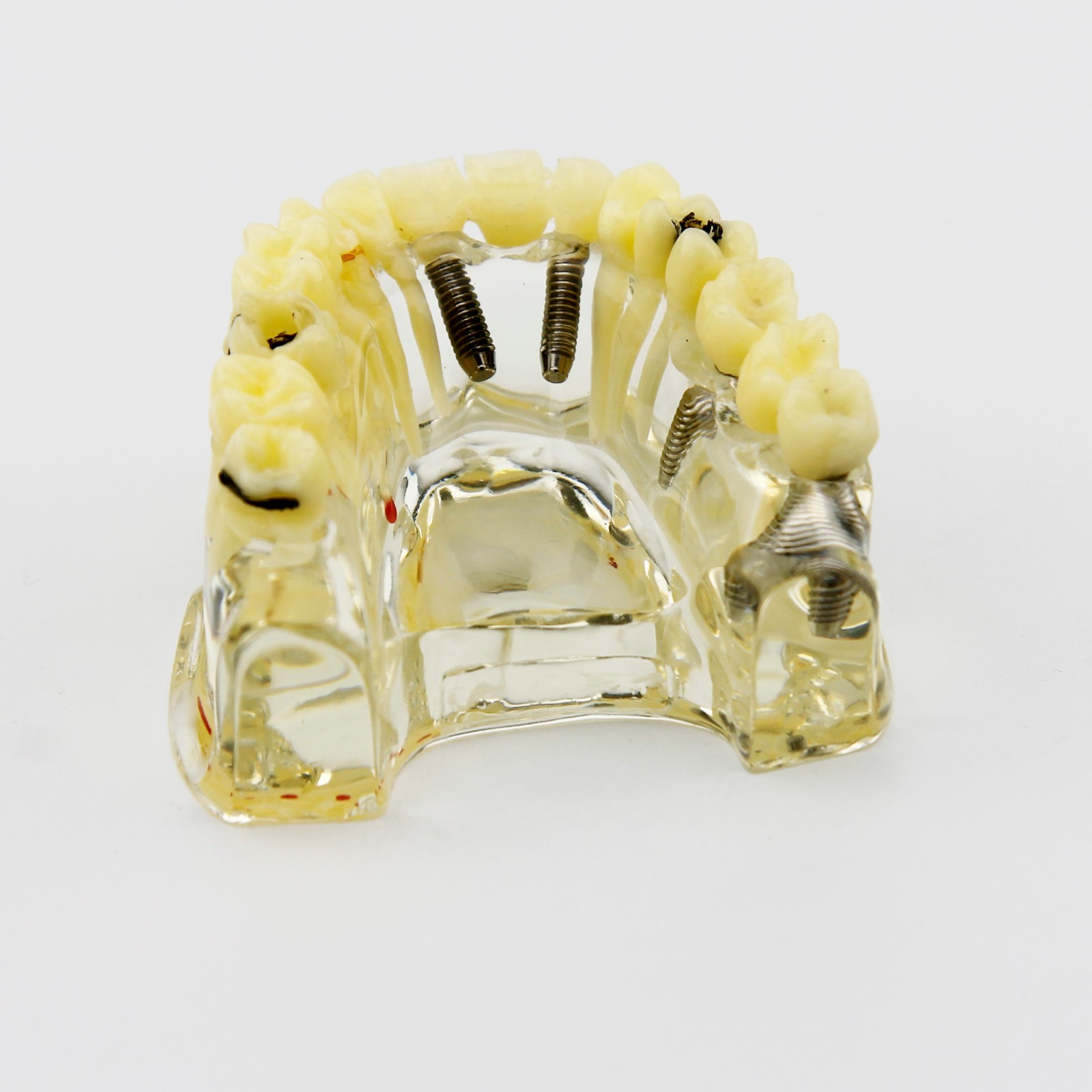 Dental Upper Jaw Implant Model with Bridge and Caries -I 2006
