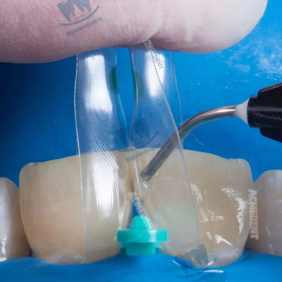 Dental Clear Matrix Diastema Matrices Wedges Similar with BioClear Matrice