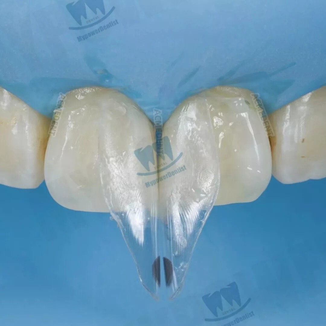 Dental Clear Matrix Diastema Matrices Wedges Similar with BioClear Matrice
