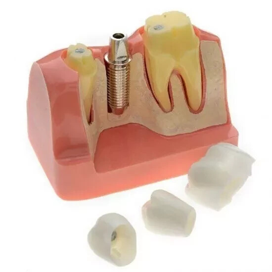 2Pc Dental Oral Analysis Crown Bridge Demonstration Tooth 4 Times Model Typodont