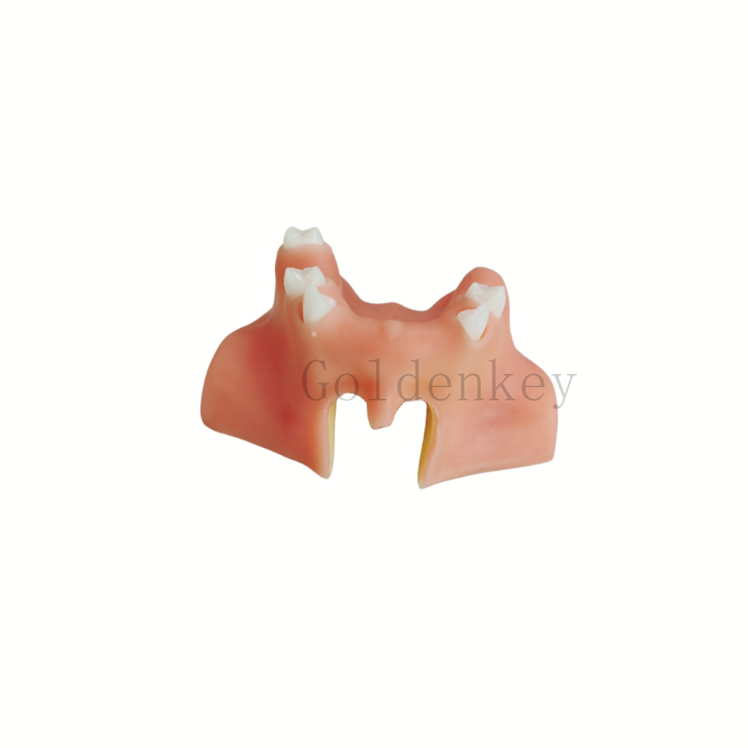 Dentist Student Tool Dental Model Upper Jaw With Crown Bridge