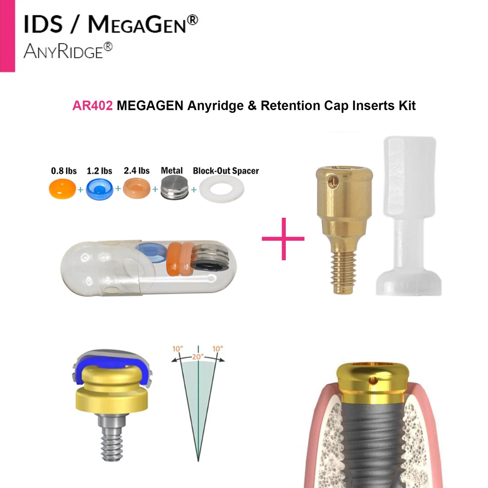 Zest Locator Overdenture Abutment Anchor For MEGAGEN AnyRidge AR Retention Caps