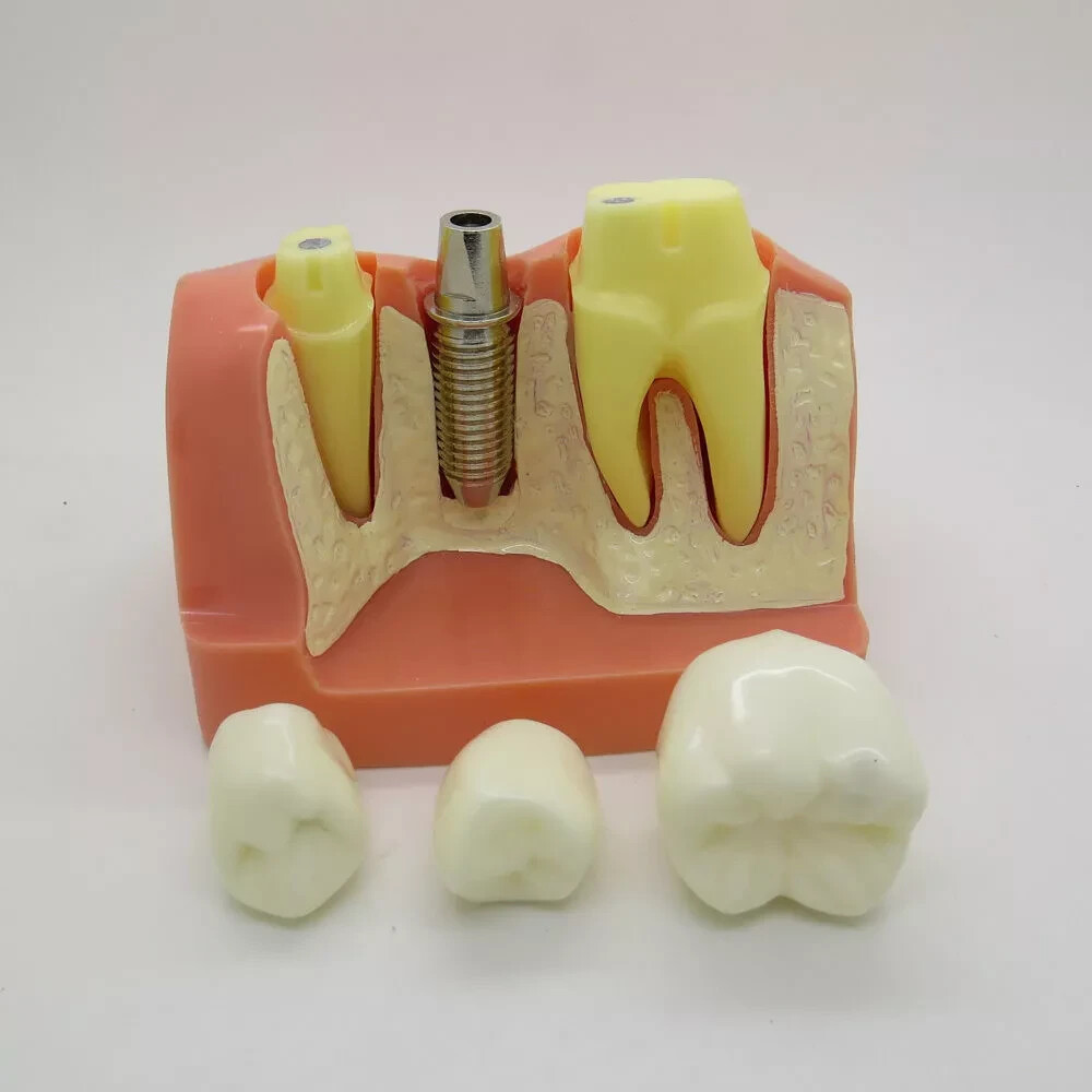 2Pc Dental Oral Analysis Crown Bridge Demonstration Tooth 4 Times Model Typodont