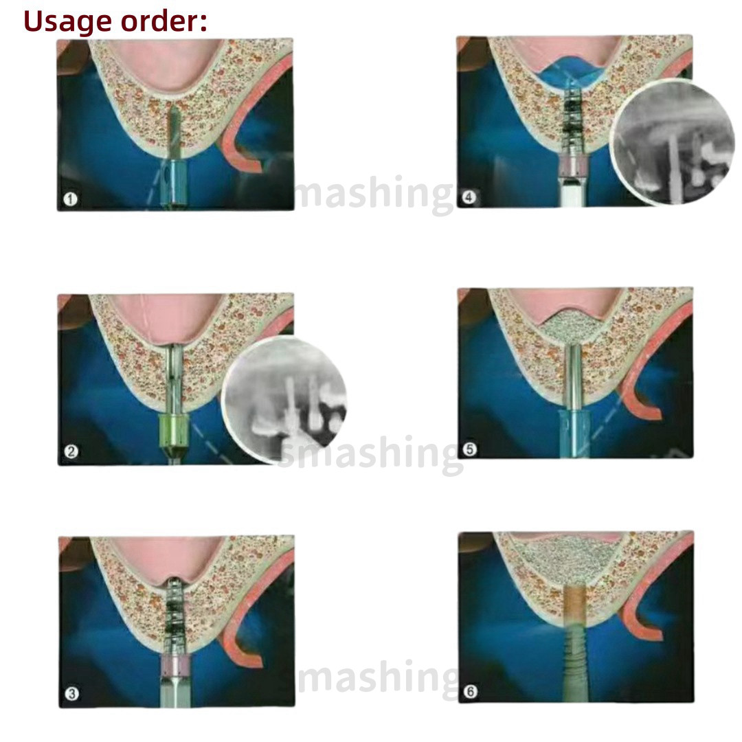 Dental Maxillary Sinus Lift Membrane Water Rising Hydraulic Tool