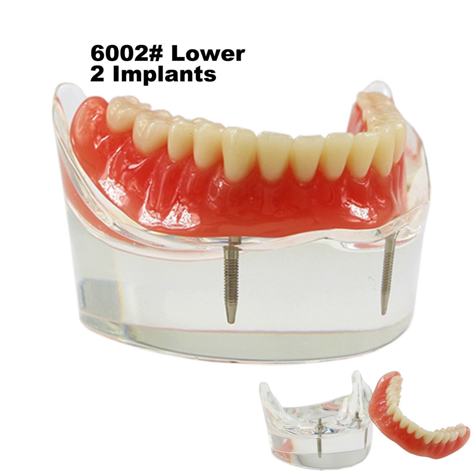 Dental Typodont Teeth Model Overdenture Lower Inferior 2 Implants Demo M-6002 US