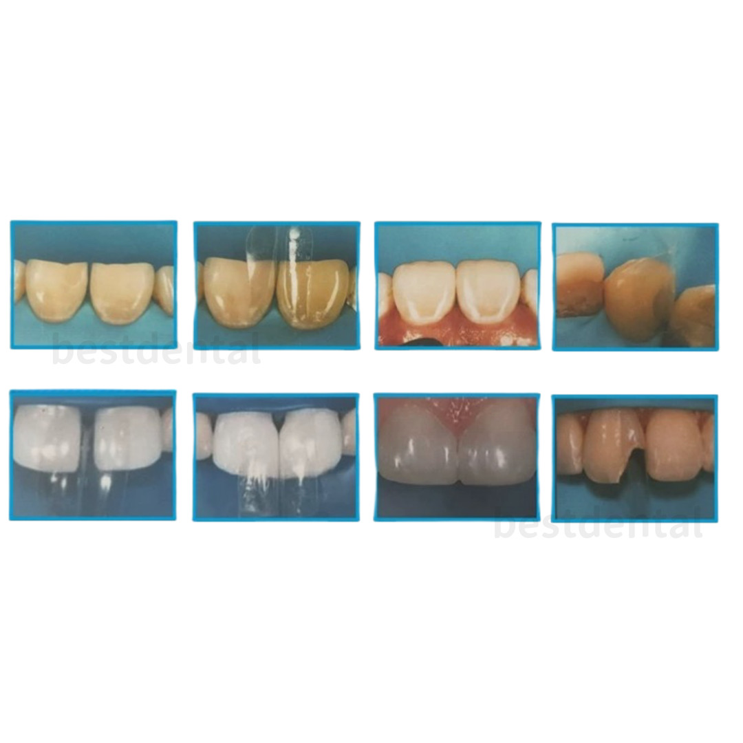 Dental Clear Matrix Transparent Anterior Matrices Bow Fit Bioclear L/M/S TOR VM