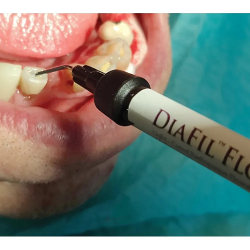 DiaDent DiaFil Flow Flowable Composite Refills Light-Cured Composite Resin