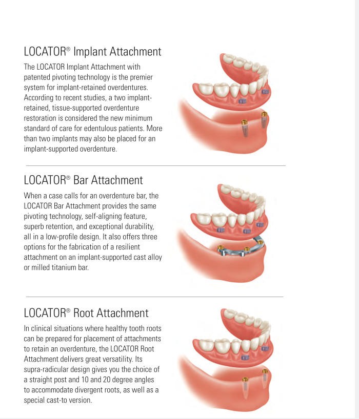 US Zest Attachment Locator Abutment Internal Conical Connection for NobelActive