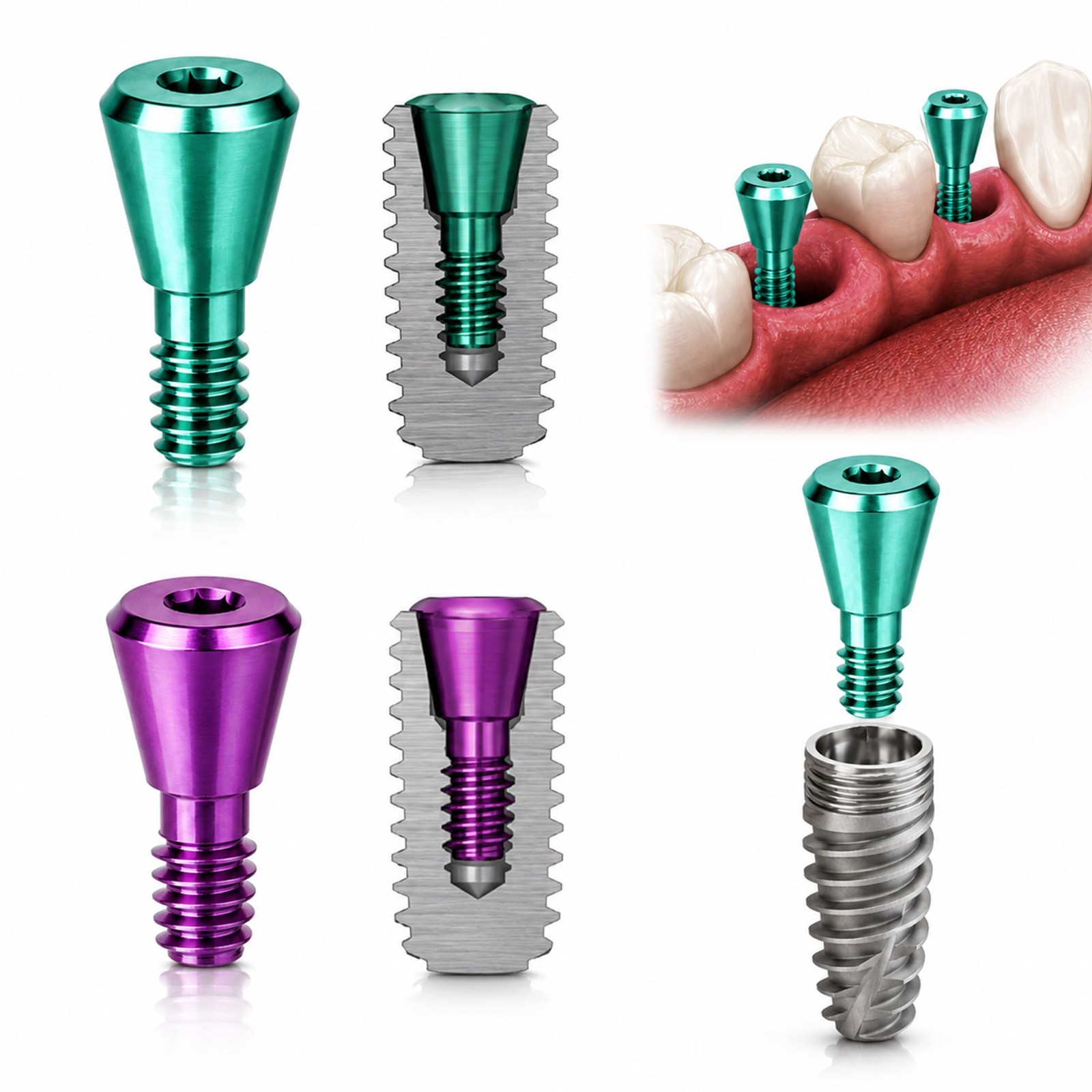 Multiple Implant Healing Abutment & Closure Cover Screw Hiossen Nobel Straumann