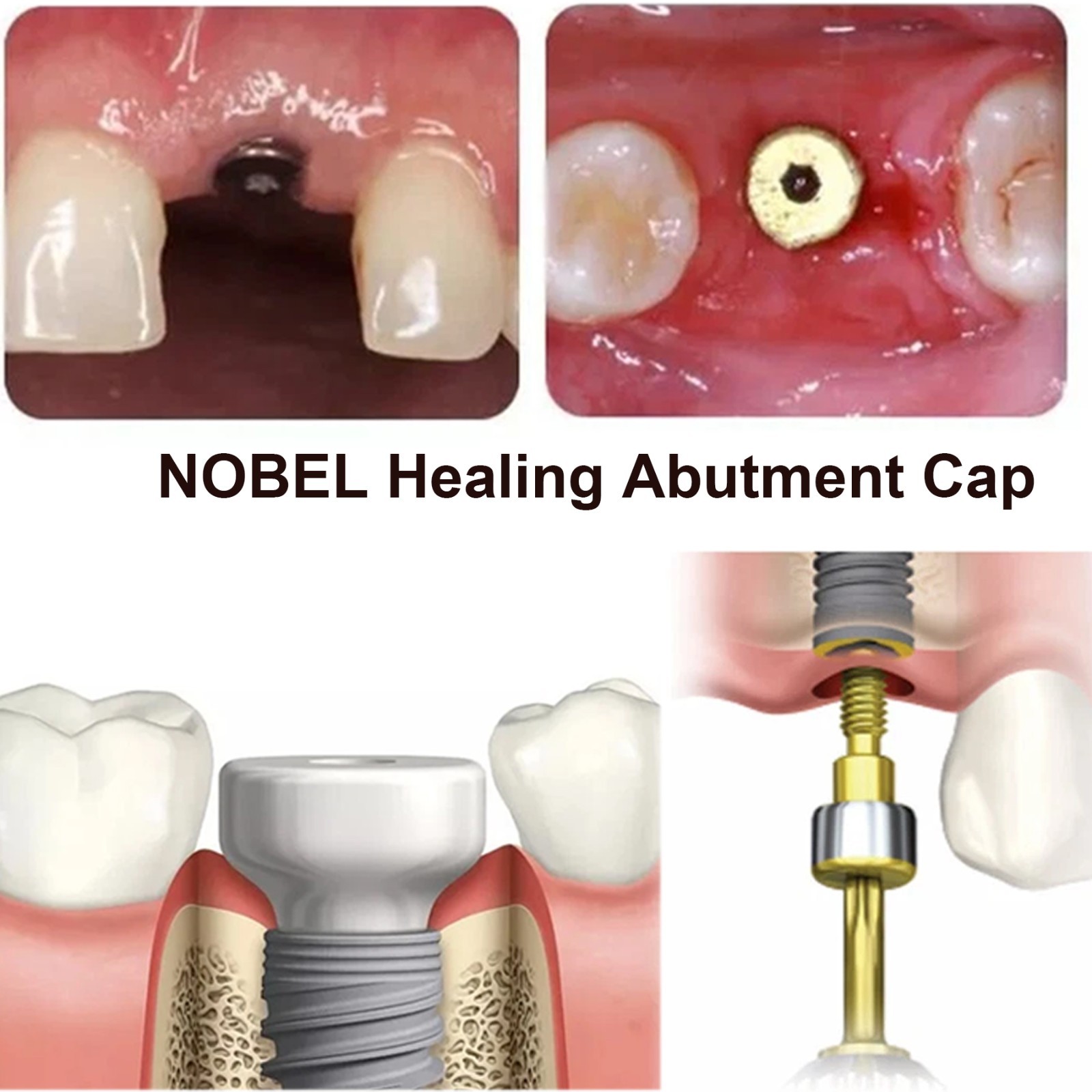 US 5Pc Dental Healing Abutment NP/RP Fit Nobel Biocare Internal Conical Titanium
