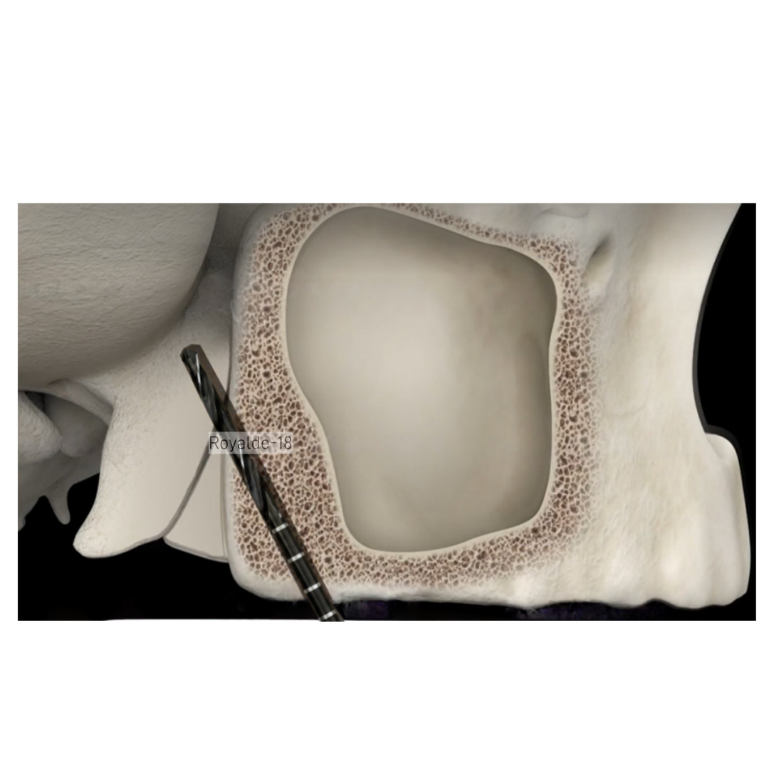 Dental Implan TPP Zygomatic Drill DLC Maxillary Tuberosity Zygomatic Impla