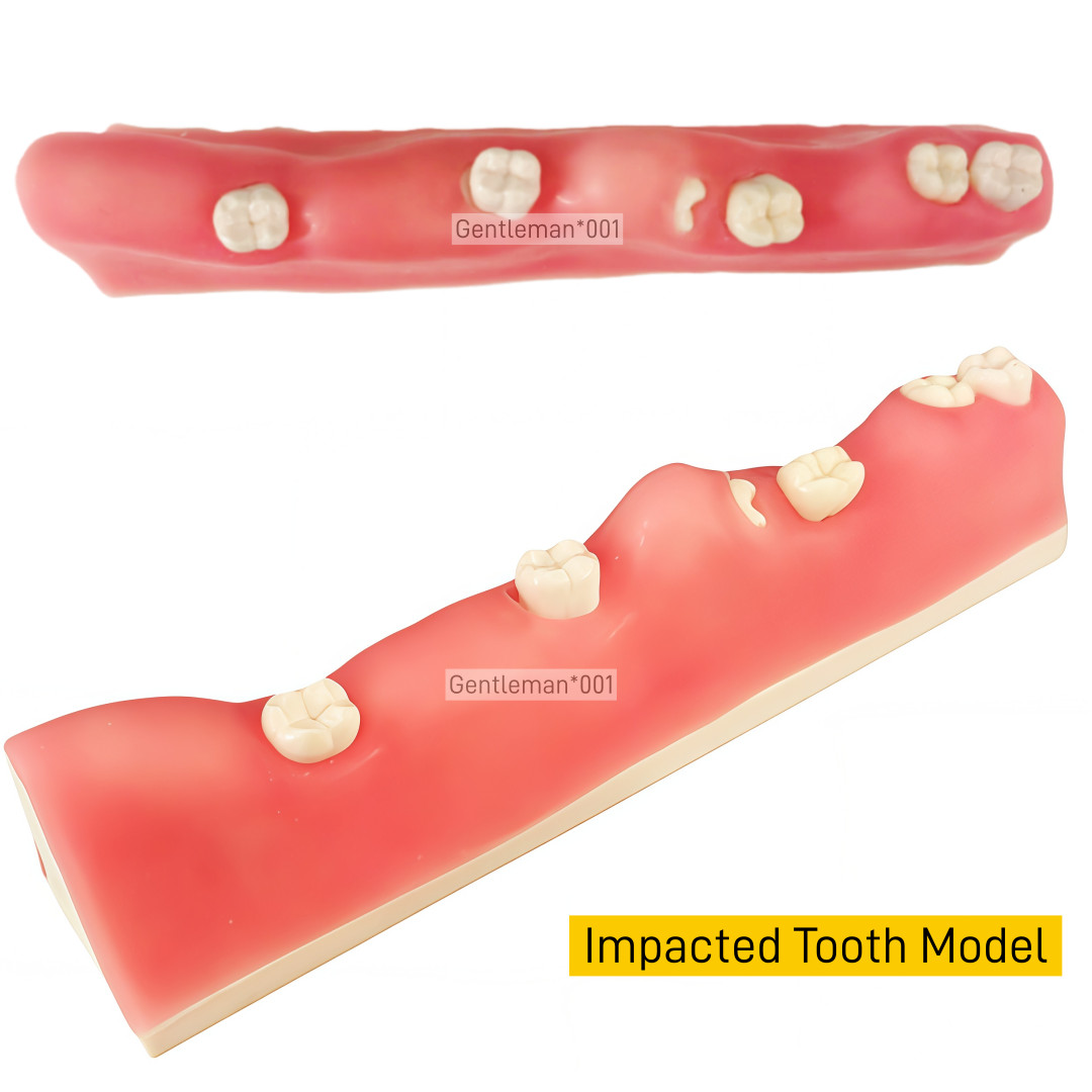 Dental Impacted Tooth Model Extraction Unerupted Tooth Practice Trainin M8038