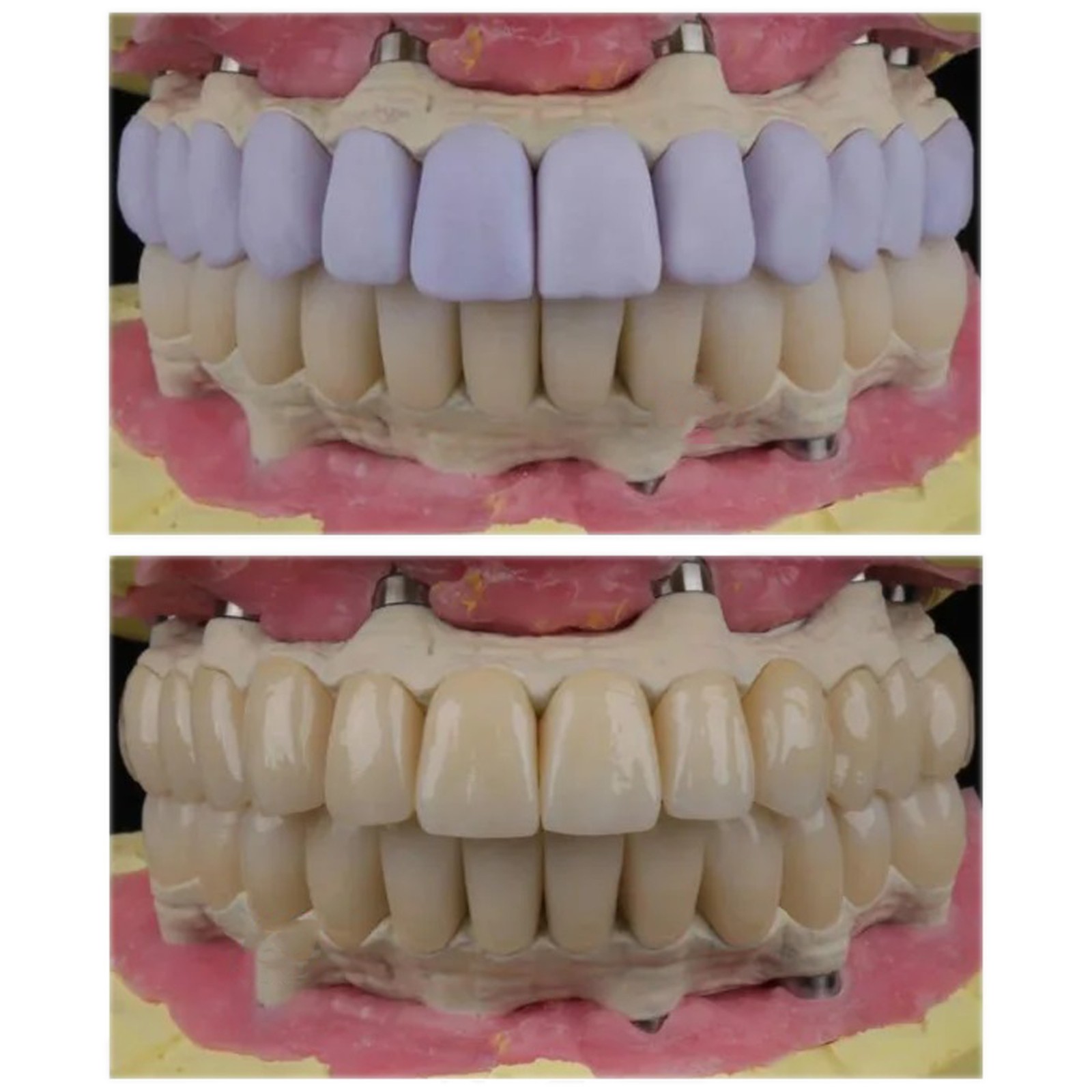 5Pcs/Box Dental C14 Glass Ceramic Lithium Dislicate Blocks Cerec CAD CAM