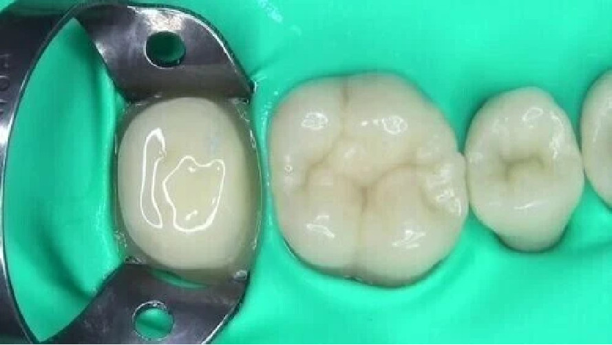 SPIDENT Core it Blue Dual Smartmix Core Buildup Flowable Dental Material 2x10gm