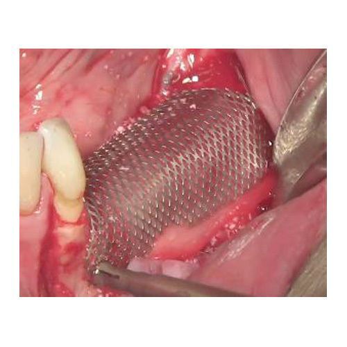 DSI Dental GBR Implant Titanium Surgical Barrier Membrane Mesh Plate 0.1mm
