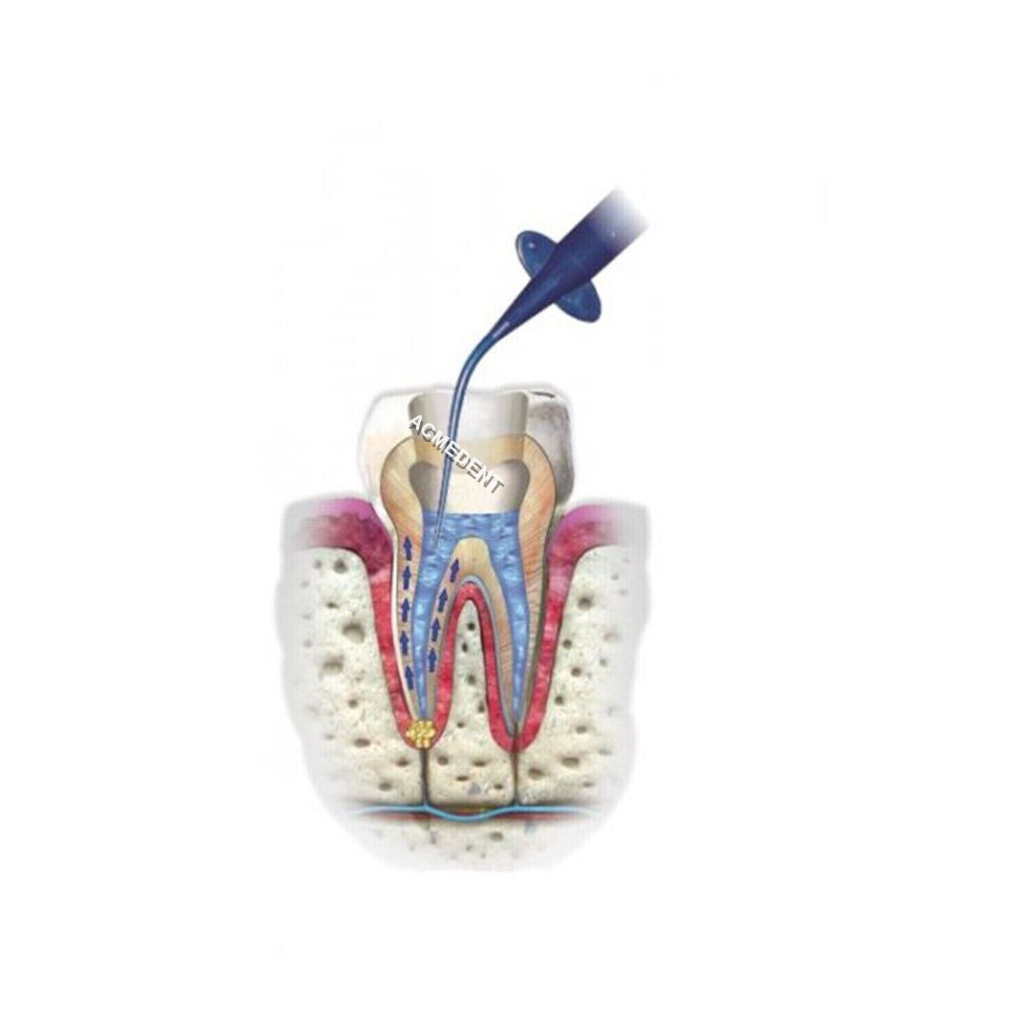 Dental Endo Aspirator Endodontic Root Canal Rinsing Tip Flushing Irrigation Tips
