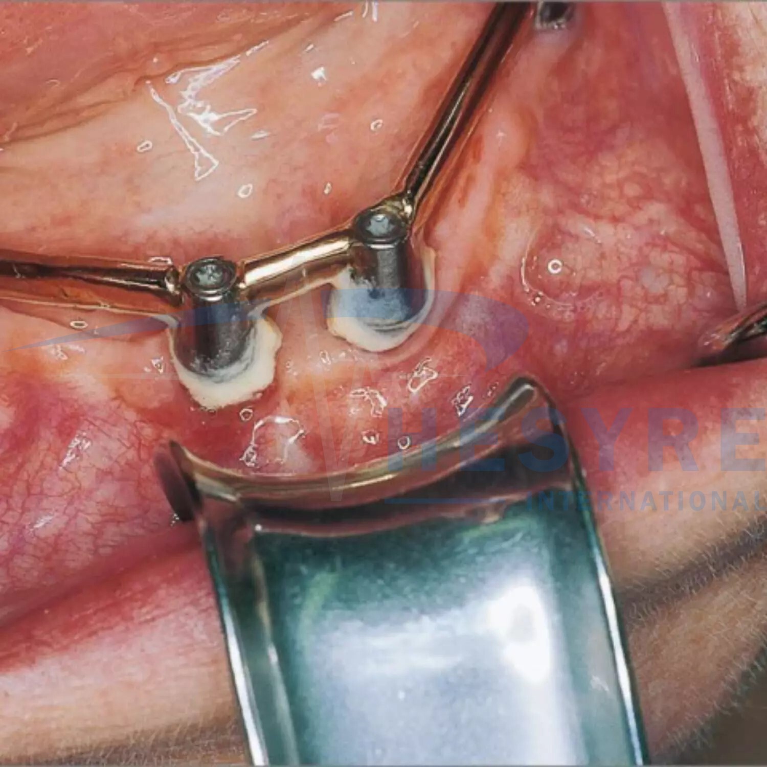Dental Implant Dentistry Minnesota Retractor with Ergonomic Handle