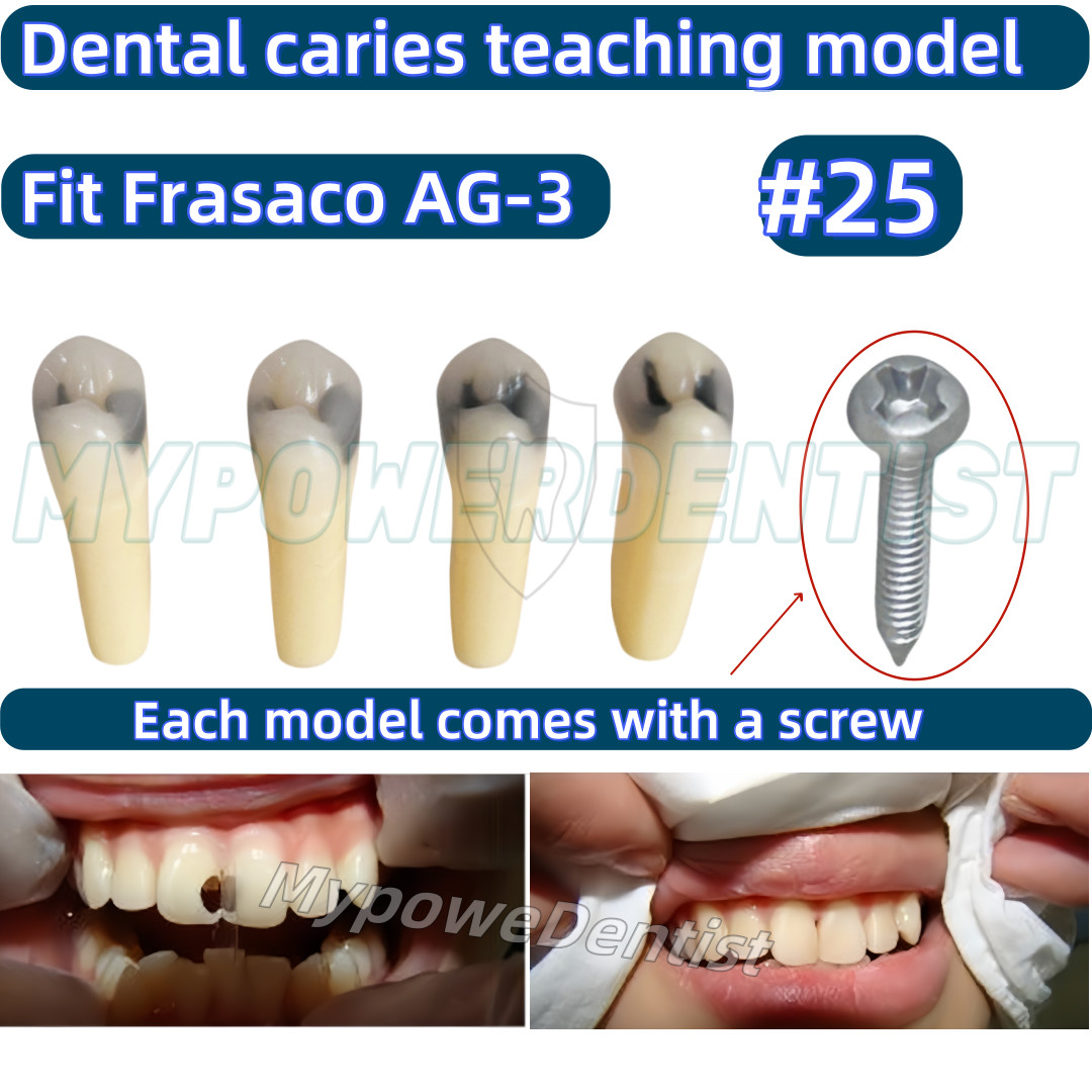 25# Dental Cavity Teeth Model Tooth Teaching Caries ModelCompatible Frasaco AG-3