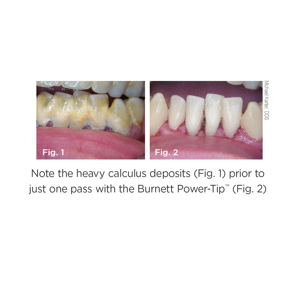 Parkell 30K Burnett Power-Tip Scaler Insert DTI30 (Pack of 1 to 5)