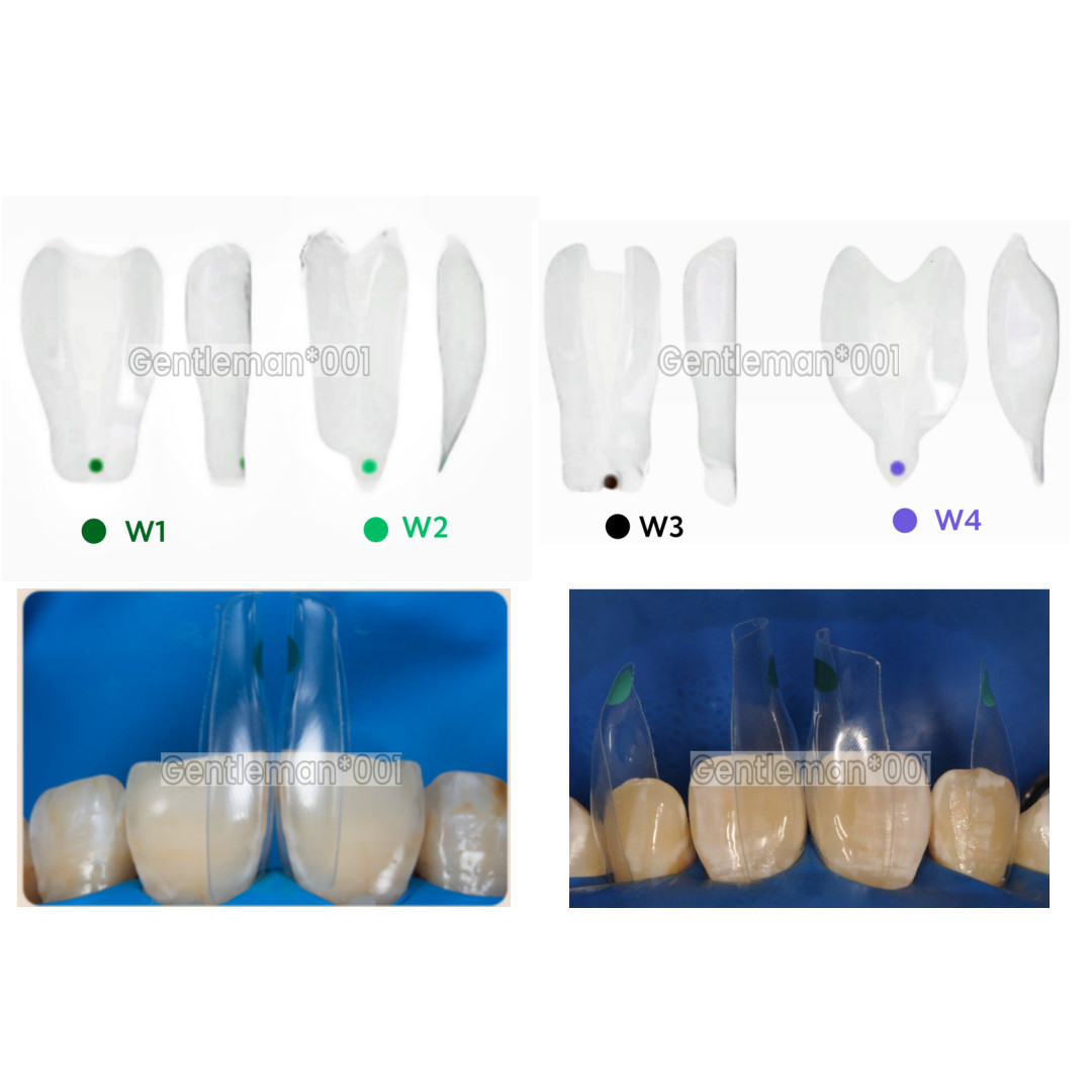 SIGNET Dental Widening Front Tranparent Clear Matrix BT Matrices Fits BioClear