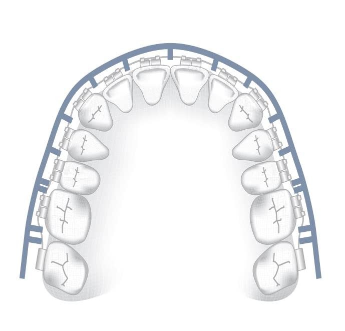 Comfort Cover for Braces, Lip Protector Mouth Guard Cushion Teeth Clear