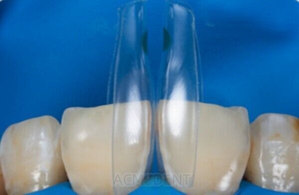 Dental Signet Anterior and Posterior Transparent Matrix Triall Molding Kit