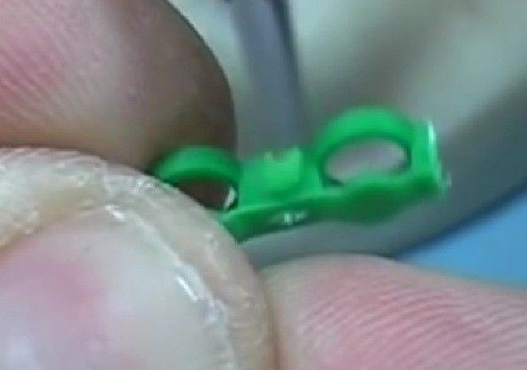 DSI Dental Lab Fixture OT Box Micro Castable Overdenture Ball Attachment Kit