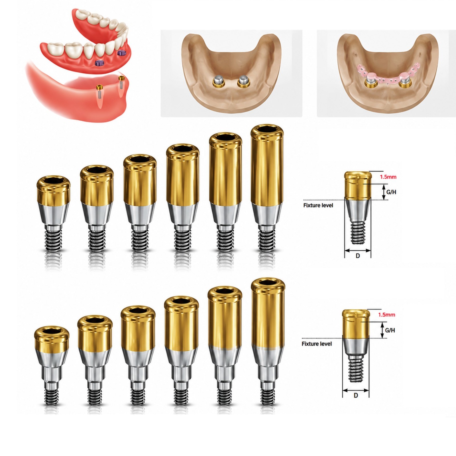 US HIOSSEN ET Locator Overdenture Abutment Mini/Regular Platform Oss Attachment