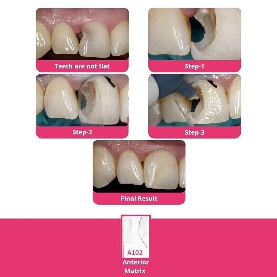 BioClear Anterior Kit Modern Matrix System for Esthetic Restorations (Free Ship)